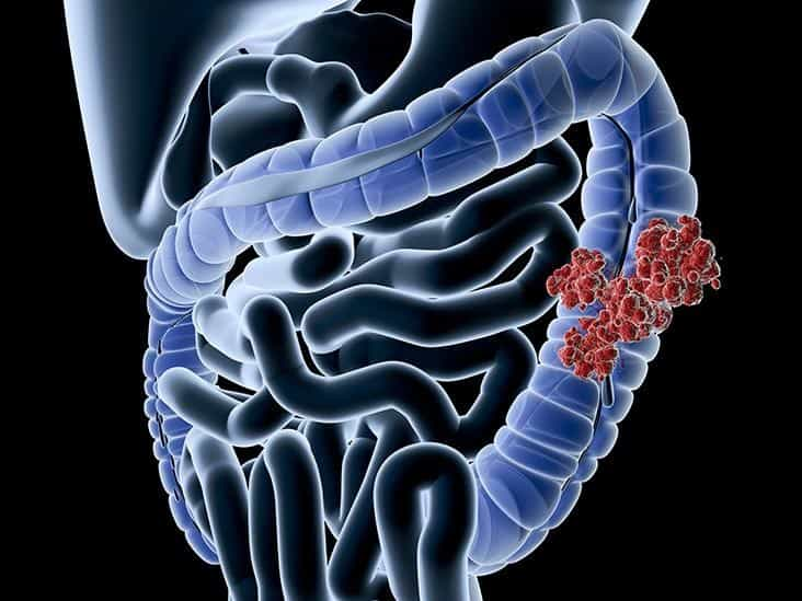 Various Symptoms of Colorectal Cancer and How to Recognize It