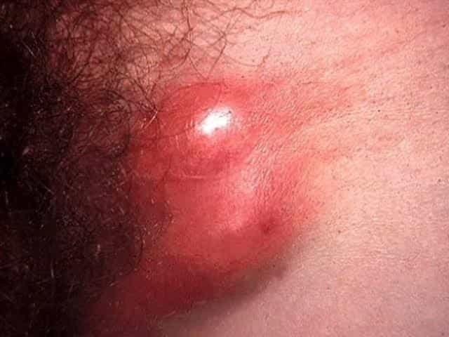 Lymphogranuloma Venereum (LGV)