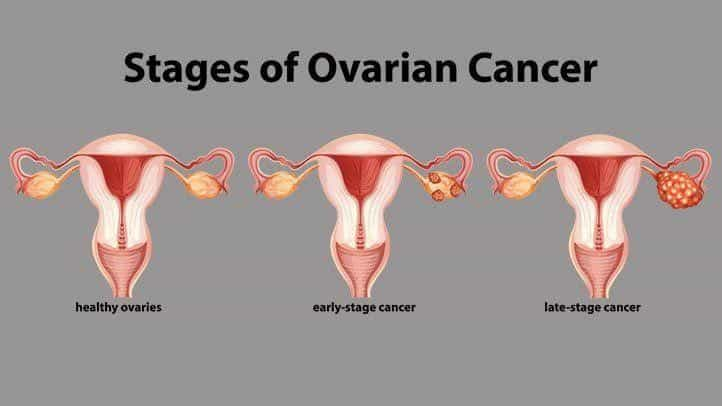 Symptoms of Ovarian Cancer and How to recognize it