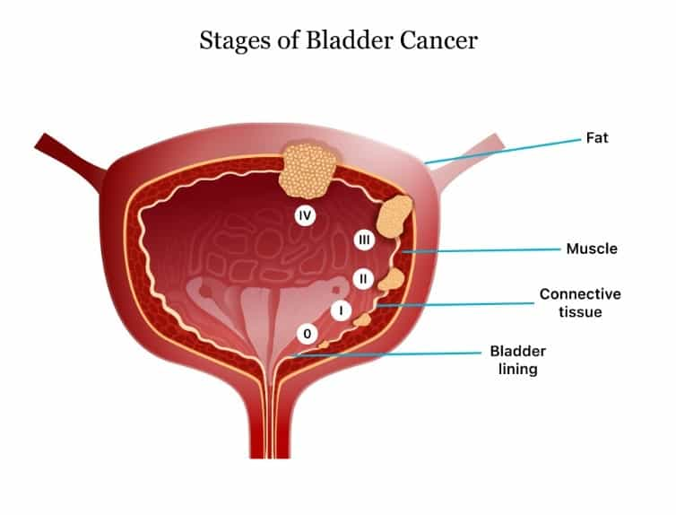 Treatment Options for Bladder Cancer