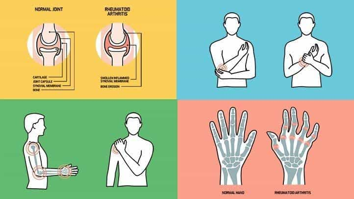 Various Symptoms of Rheumatoid Arthritis and How to Recognize them