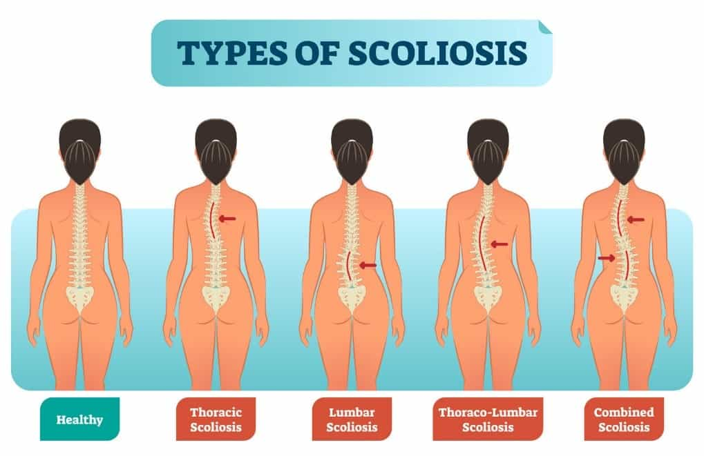 Scoliosis Disorder