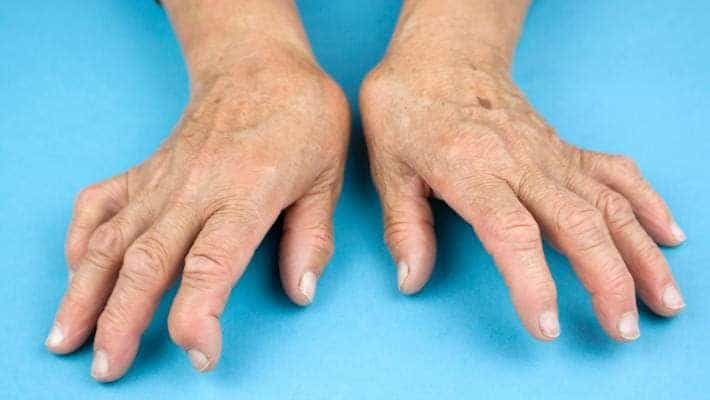 Various Treatment Options for Rheumatoid Arthritis