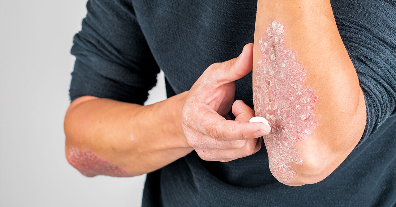 psoriasis traditional treatments