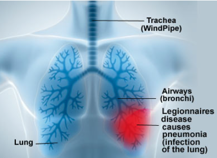 What is Legionellosis?